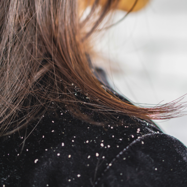 Dry Scalp or Dandruff 1